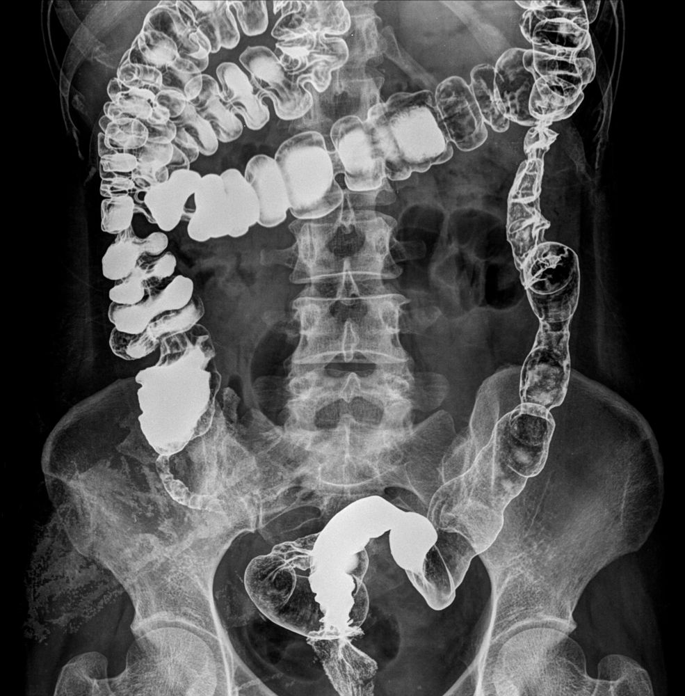 Bariatric Surgery and Long Acting Medications