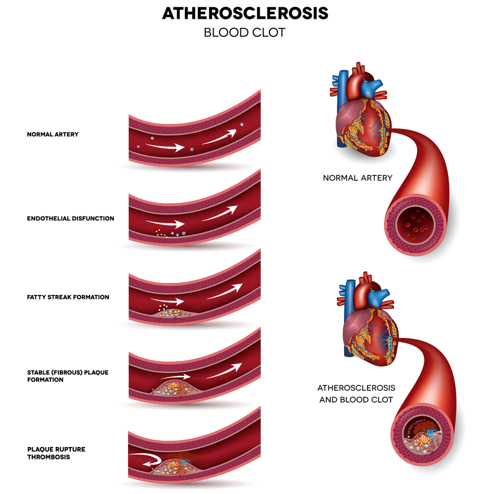 Clots