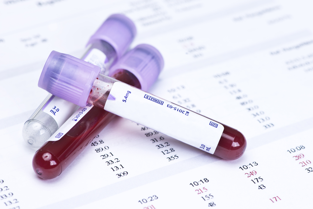 Drug Induced Hypercalcemia