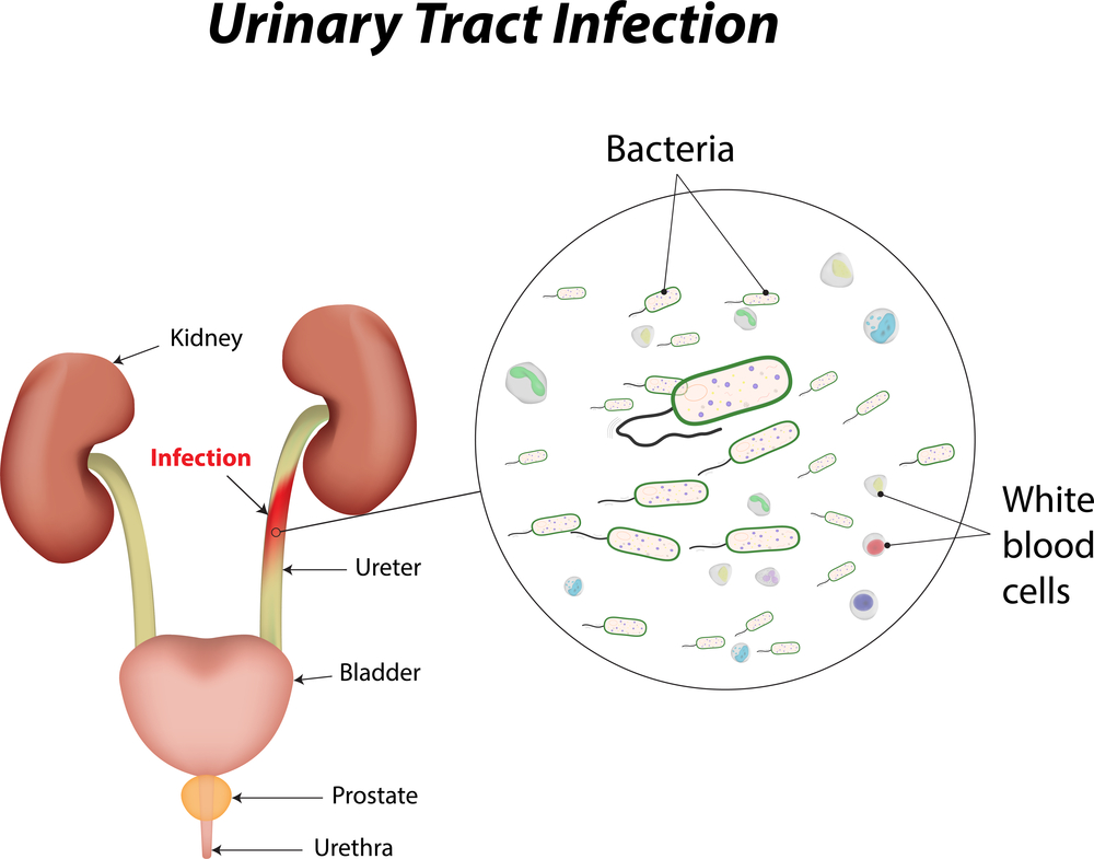 Overactive Bladder and UTI Case