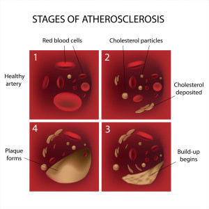 Drug Induced Hypertension Case