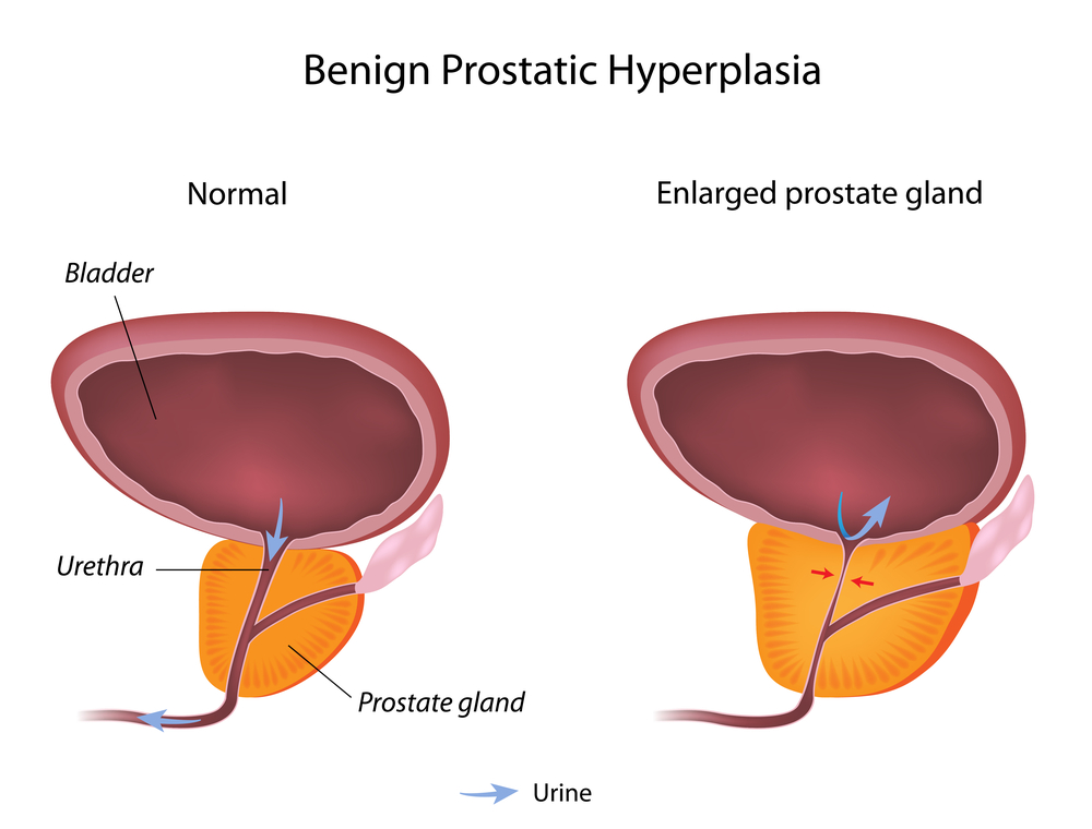 Anticholinergics can Worsen BPH