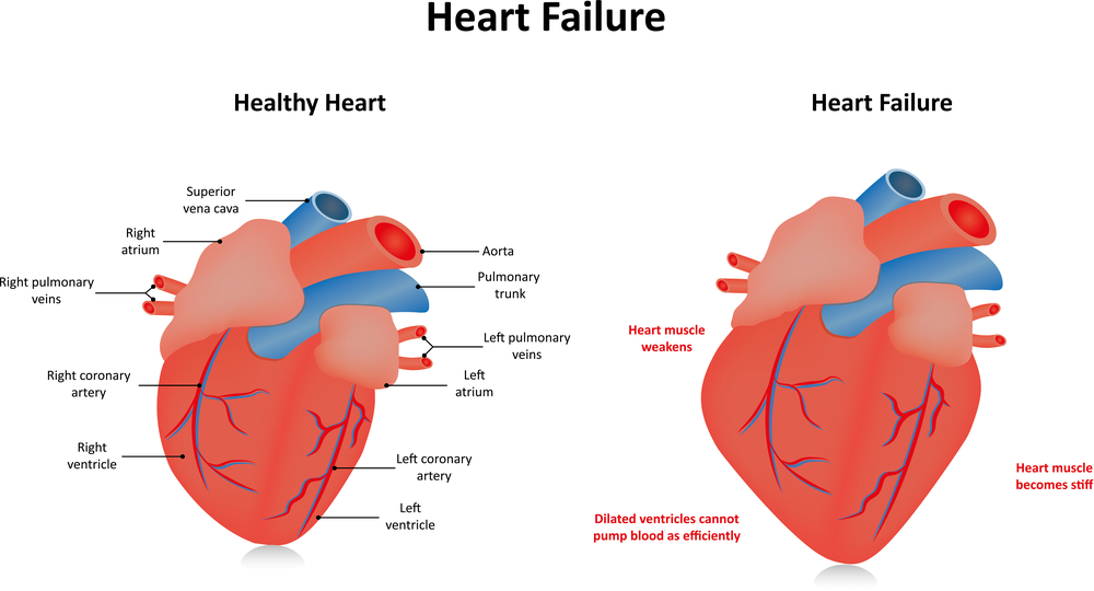 Actos (pioglitazone) and CHF