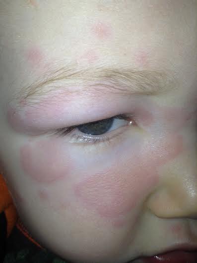 Amoxicillin Allergy Or Something Else Med Ed 101