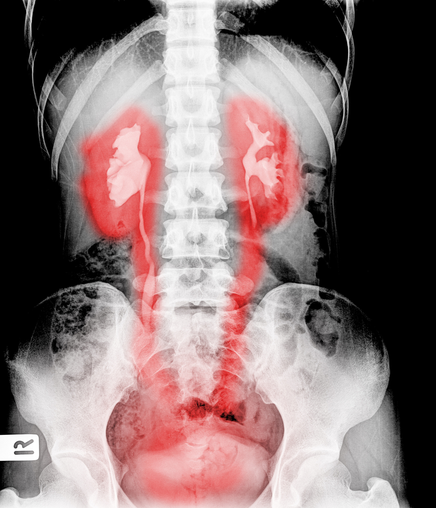 What Are Loop Diuretics?