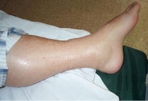 Leg_Edema NSAIDs
