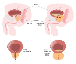 Meet Midodrine, an Alpha Agonist - Case Study