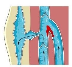 Drug Induced DVT?