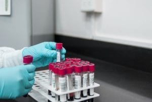 Lab monitoring in HIV