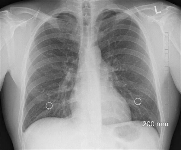 Tiotropium Systemic Absorption – How Much?