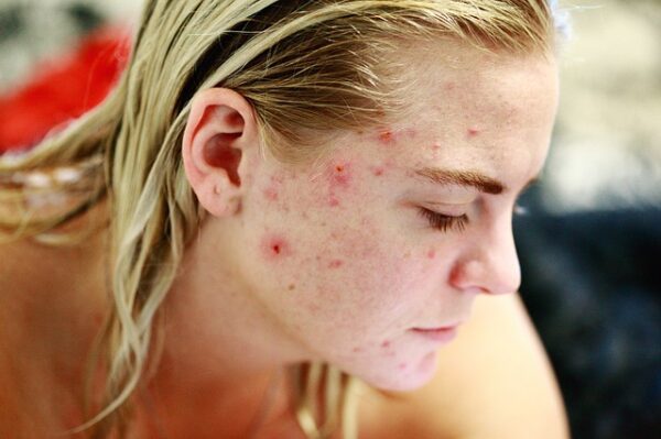 Acne Treatment Guidelines and Clinical Pearls