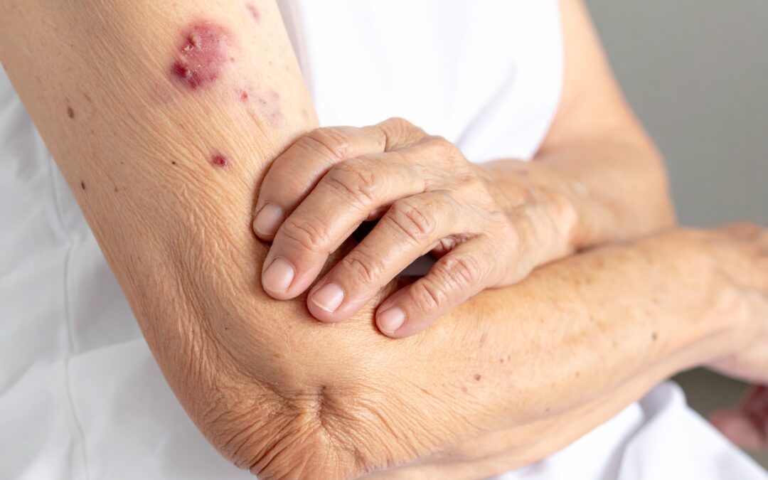 Apixaban Dose Adjustment and Bleeding Risk