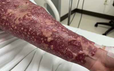 Lamotrigine Lawsuits – Here’s Why