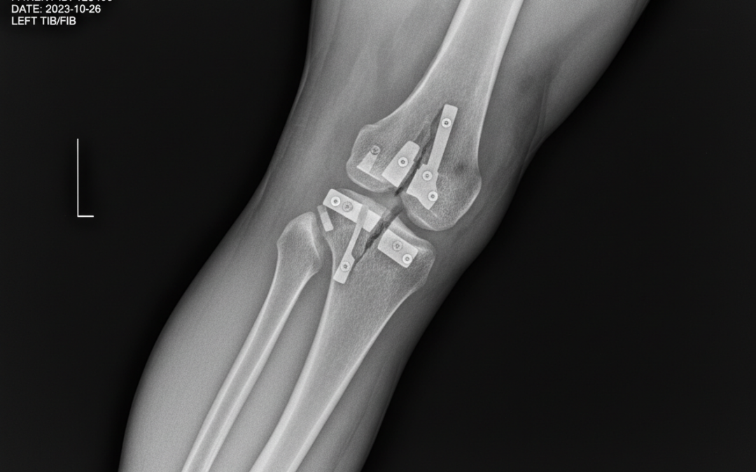 Oral Bisphosphonates – NAPLEX Test Prep and Practice Pearls