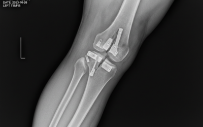 Oral Bisphosphonates – NAPLEX Test Prep and Practice Pearls