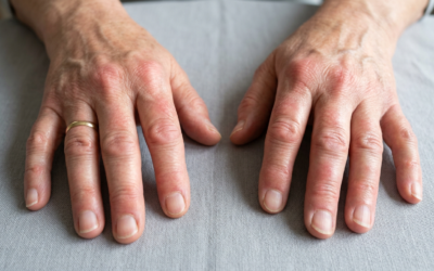Rheumatoid Arthritis Case Review